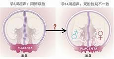 异卵是几个胎盘